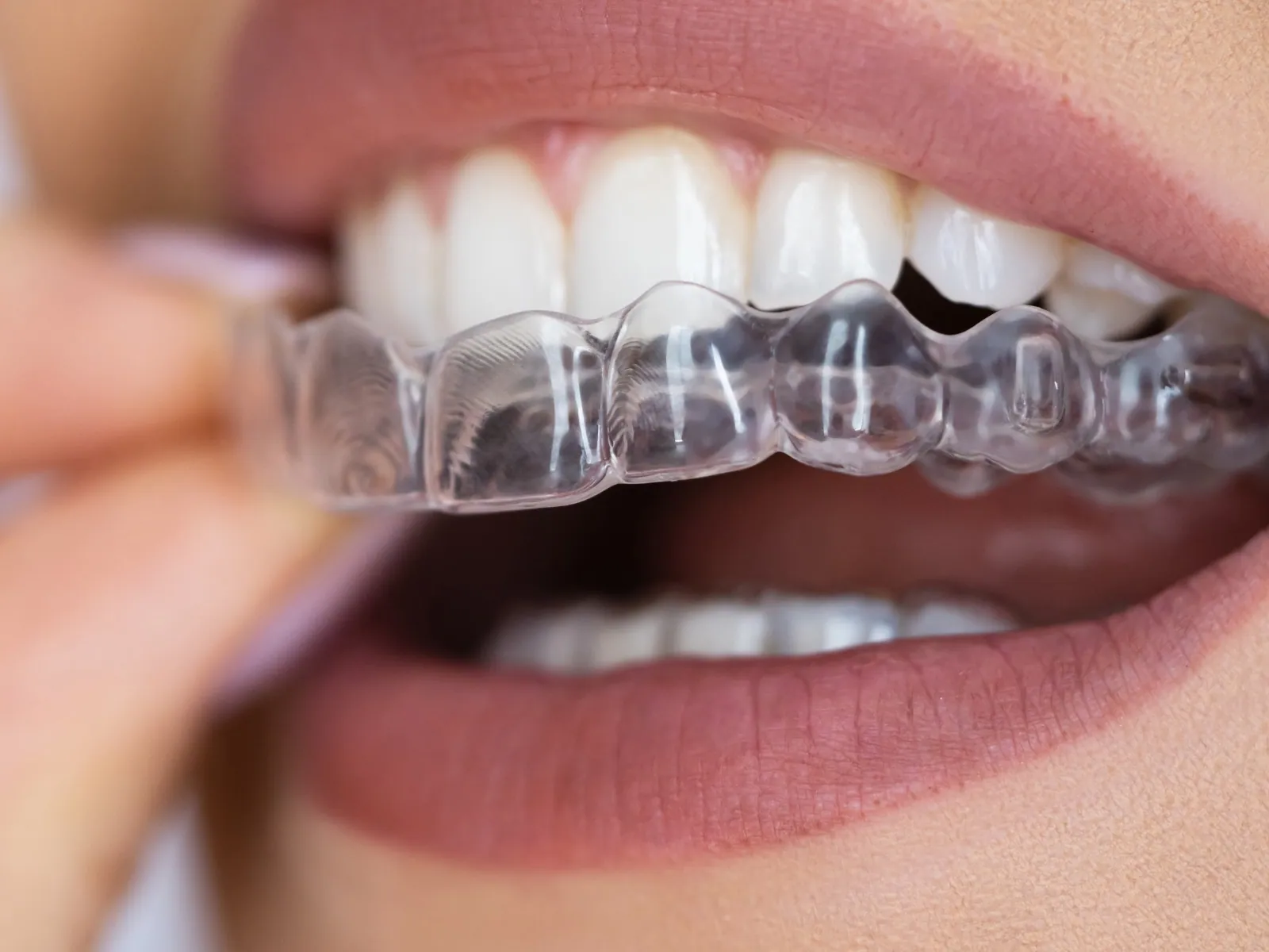 Custom mouth guard consultation at Urban Dental Care in Woodridge