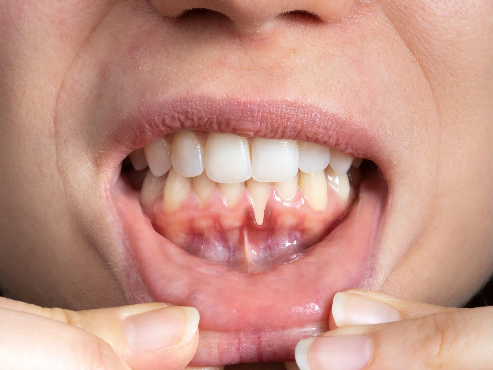 Close view of a patient's lower gums and gumline