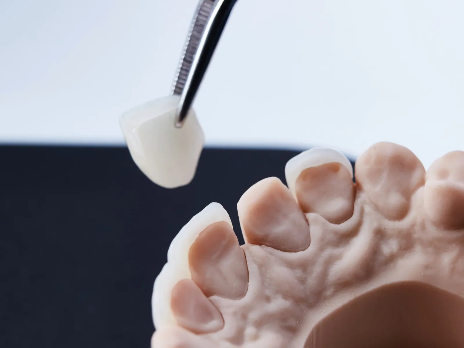 Dental veneers consultation for cosmetic dentistry in Woodridge