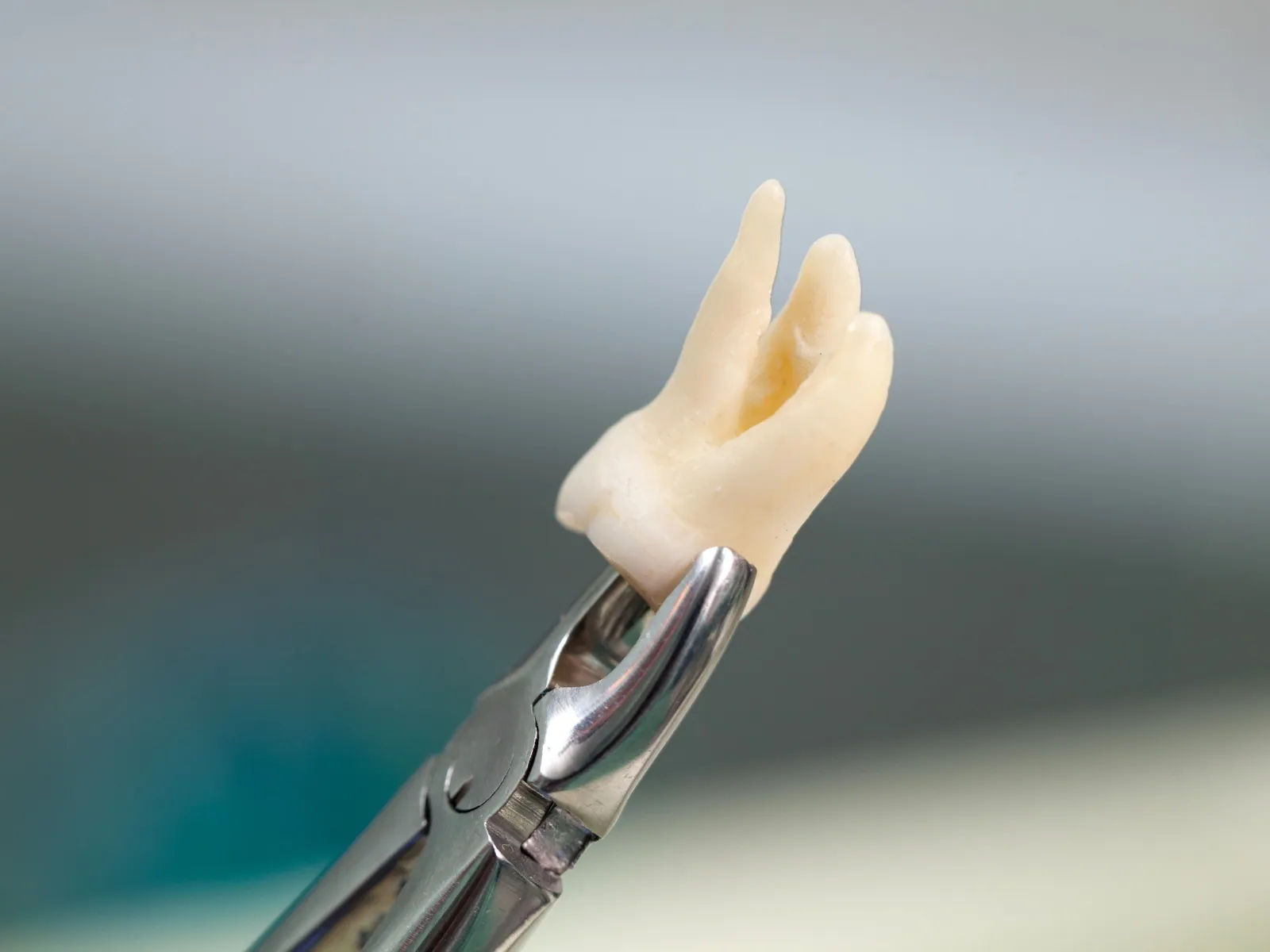 Wisdom tooth removal consultation in Woodridge
